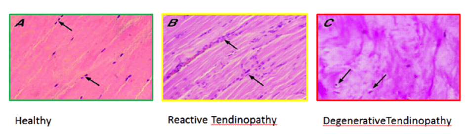 Tendon Injuries Physio Penrith