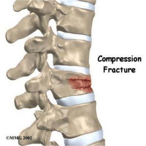 Frail bones Osteoporosis