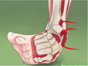 ankle sprain physio