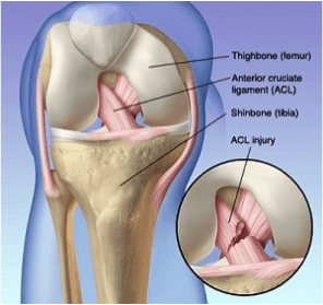 Physio ACL