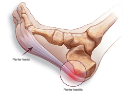 tendon pain