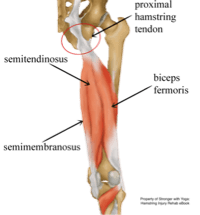 tendinopathy