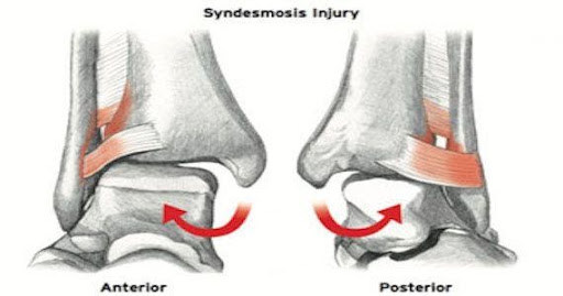 Syndesmosis Injury